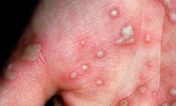 Palmoplantar psoriasis medscape. Seborrheás dermatitisz psoriasis és tinea pedis