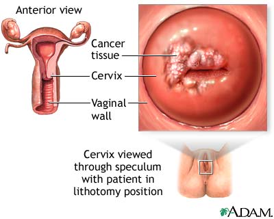 varicoza venelor de col uterin