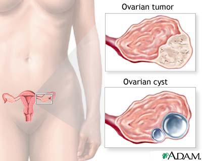 Poza: cancer ovarian
