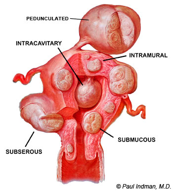 localizari fibrom uterin