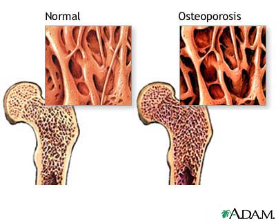 dureri de șold în tratamentul osteoporozei