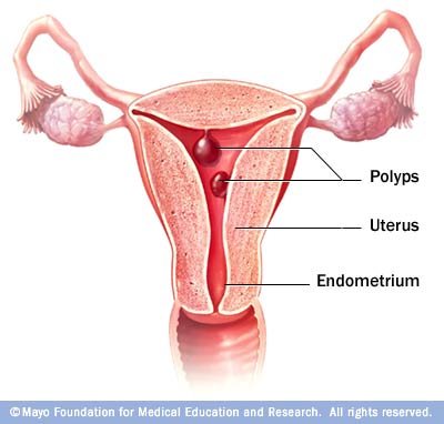 poate polipul endometrial provoca pierderea în greutate)