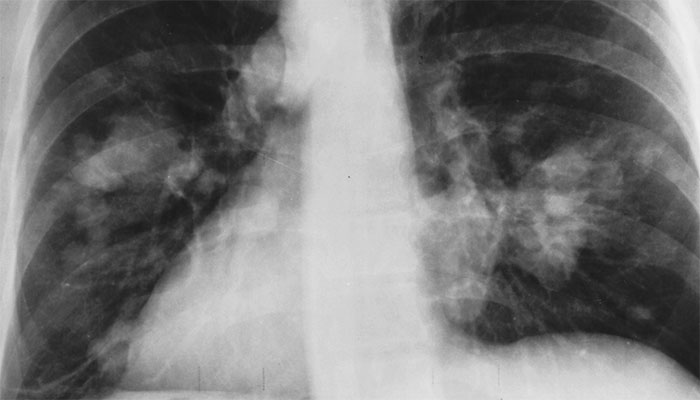 Simptome ale cancerului pulmonar