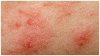 dureri articulare mâncărime și roșeață a pielii