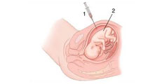Amniocenteza - Indicatii, Riscuri, Pret + Video