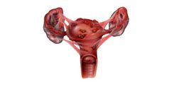 Endometrioza - Cauze, Simptome, Diagnostic, Tratament
