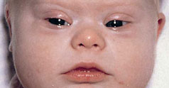 Sindromul Down : 1 Bebelus din 800