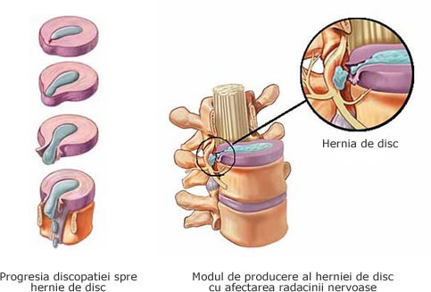 5 simptome că suferi de hernie de disc cervicală